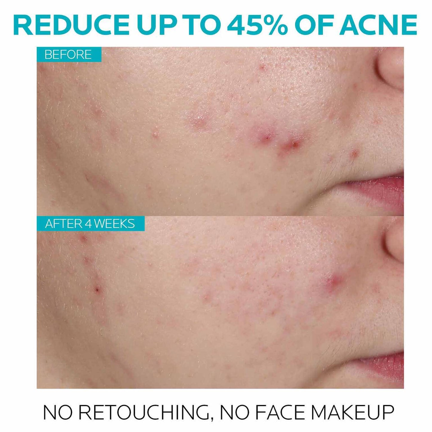 effaclar-salicylic-acid-acne-treatment-serum-s6 7_EffaclarSerum_After-45-days.jpg