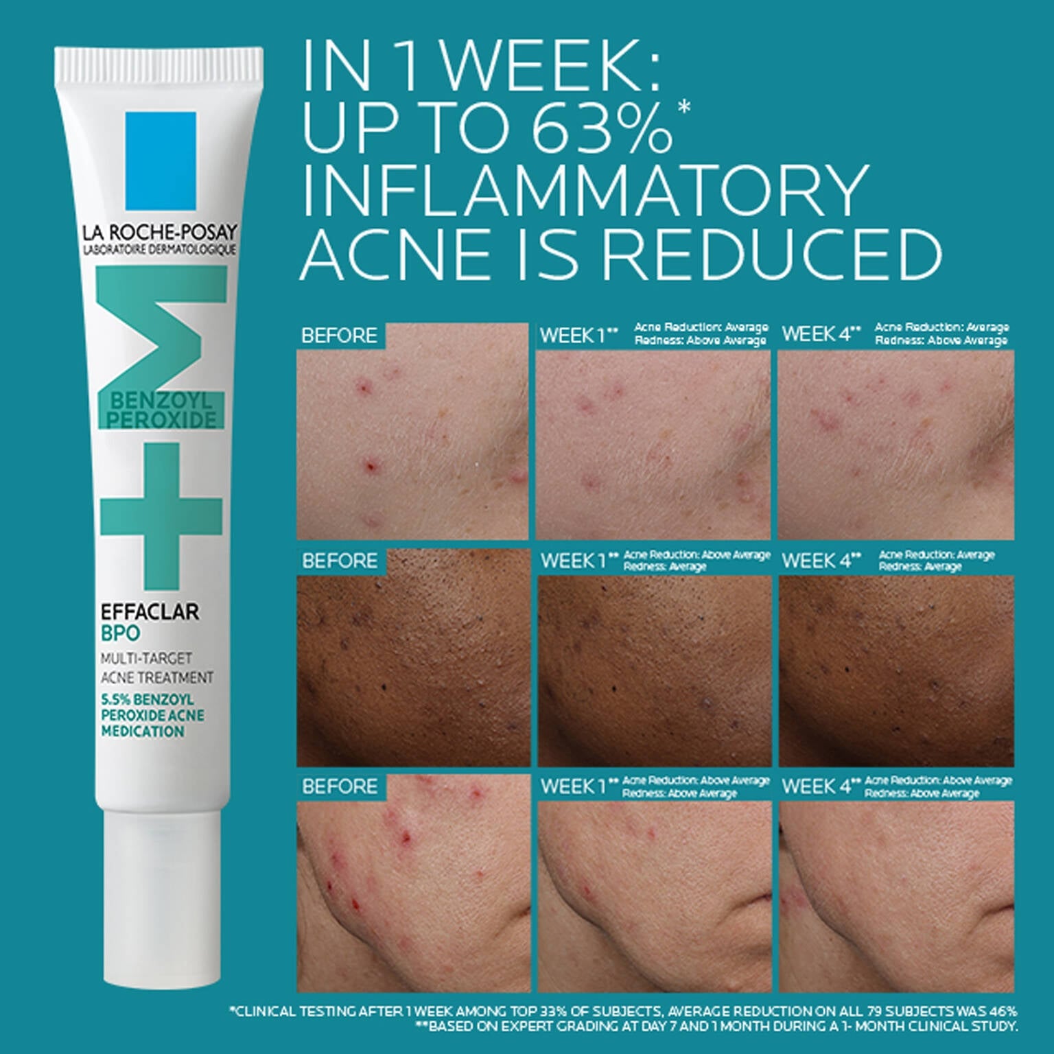effaclar-bpo-multi-target-acne-treatment-with-5-5-benzoyl-peroxide-m8 EffaclarBPO-ClinicalBA-ATF-1500x1500-2.jpg