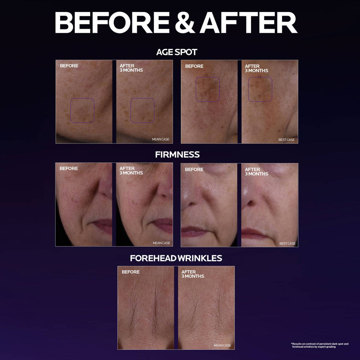 mela-b3-double-dose-discoloration-treatment-with-melasyltm-u3 MelaB3_DD_BTF_BeforeAfter_1500x1500_5.jpg